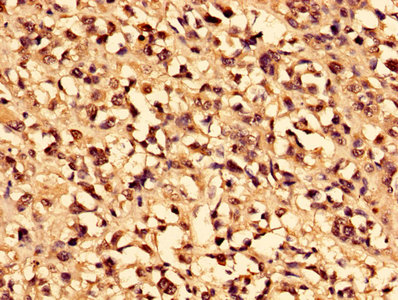 CA1 / Carbonic Anhydrase I Antibody - Immunohistochemistry of paraffin-embedded human melanoma using CA1 Antibody at dilution of 1:100