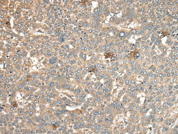 CA11 / Carbonic Anhydrase XI Antibody - Immunohistochemistry of paraffin-embedded Human liver cancer tissue  using CA11 Polyclonal Antibody at dilution of 1:45(×200)