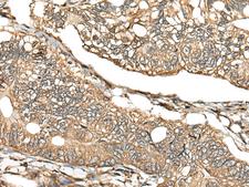 CA11 / Carbonic Anhydrase XI Antibody - Immunohistochemistry of paraffin-embedded Human gastric cancer tissue  using CA11 Polyclonal Antibody at dilution of 1:30(×200)