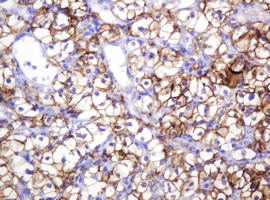 CA12 / Carbonic Anhydrase XII Antibody - IHC of paraffin-embedded Carcinoma of Human kidney tissue using anti-CA12 mouse monoclonal antibody.