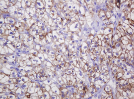 CA12 / Carbonic Anhydrase XII Antibody - IHC of paraffin-embedded Carcinoma of Human kidney tissue using anti-CA12 mouse monoclonal antibody.