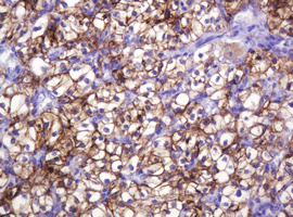 CA12 / Carbonic Anhydrase XII Antibody - IHC of paraffin-embedded Carcinoma of Human kidney tissue using anti-CA12 mouse monoclonal antibody. (Heat-induced epitope retrieval by 10mM citric buffer, pH6.0, 120°C for 3min).