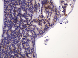 CA12 / Carbonic Anhydrase XII Antibody - IHC of paraffin-embedded Carcinoma of Human thyroid tissue using anti-CA12 mouse monoclonal antibody. (Heat-induced epitope retrieval by 10mM citric buffer, pH6.0, 120°C for 3min).