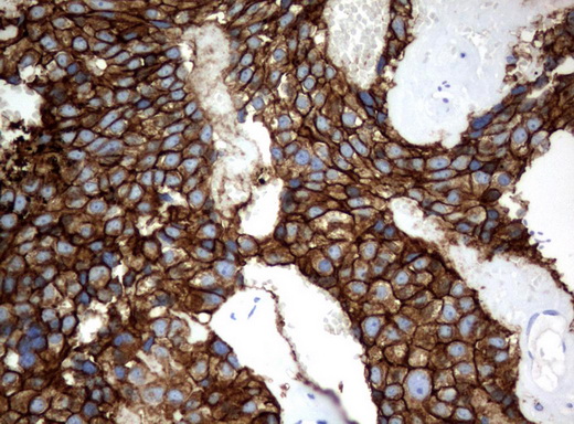 CA12 / Carbonic Anhydrase XII Antibody - Immunohistochemical staining of paraffin-embedded Adenocarcinoma of Human breast tissue using anti-CA12 mouse monoclonal antibody.  heat-induced epitope retrieval by 10mM citric buffer, pH6.0, 120C for 3min)