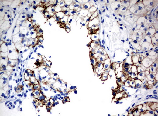 CA12 / Carbonic Anhydrase XII Antibody - Immunohistochemical staining of paraffin-embedded Carcinoma of Human kidney tissue using anti-CA12 mouse monoclonal antibody.  heat-induced epitope retrieval by 10mM citric buffer, pH6.0, 120C for 3min)