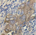 CA125 Antibody - Bladder adenocarcinoma