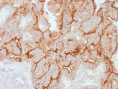 CA125 Antibody - Formalin-fixed, paraffin-embedded human Ovarian Carcinoma stained with MUC16 Rabbit Recombinant Monoclonal Antibody (OCA125/2349R).