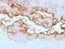 CA125 Antibody - Formalin-fixed, paraffin-embedded human Endometrial Carcinoma stained withMUC16 Rabbit Recombinant Monoclonal Antibody (OCA125/2349R).