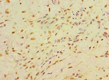 CA14 / Carbonic Anhydrase XIV Antibody - Immunohistochemistry of paraffin-embedded human breast cancer at dilution 1:100