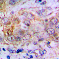 CA2 / Carbonic Anhydrase II Antibody - Immunohistochemical analysis of Carbonic Anhydrase 2 staining in human lung cancer formalin fixed paraffin embedded tissue section. The section was pre-treated using heat mediated antigen retrieval with sodium citrate buffer (pH 6.0). The section was then incubated with the antibody at room temperature and detected using an HRP conjugated compact polymer system. DAB was used as the chromogen. The section was then counterstained with hematoxylin and mounted with DPX.