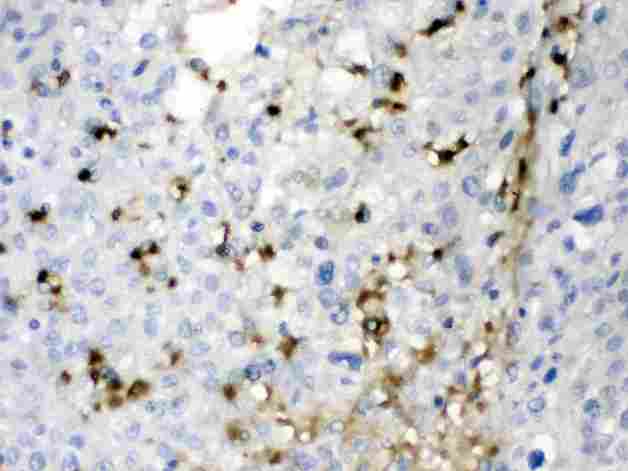 CA2 / Carbonic Anhydrase II Antibody - CA2 was detected in paraffin-embedded sections of human liver cancer tissues using rabbit anti- CA2 Antigen Affinity purified polyclonal antibody