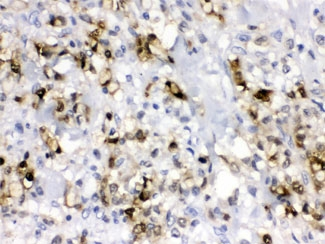 CA2 / Carbonic Anhydrase II Antibody - IHC testing of FFPE human gastric cancer tissue with CA2 antibody at 1ug/ml. HIER: steam in pH6 citrate buffer and allow to cool prior to staining.