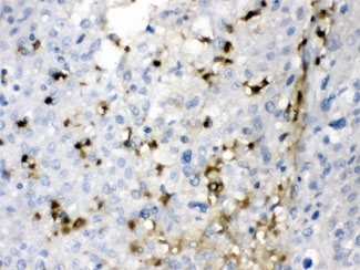 CA2 / Carbonic Anhydrase II Antibody - IHC testing of FFPE human liver cancer tissue with CA2 antibody at 1ug/ml. HIER: steam in pH6 citrate buffer and allow to cool prior to staining.