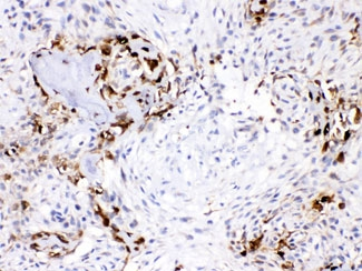 CA3 / Carbonic Anhydrase III Antibody - IHC testing of FFPE human osteosarcoma with CA3 antibody at 1ug/ml. HIER: steam section in pH6 citrate buffer for 20 min.