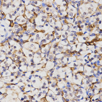 CA4 / Carbonic Anhydrase IV Antibody - Immunohistochemistry of paraffin-embedded human kidney cancer tissue.