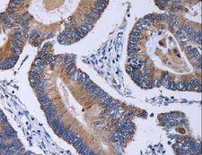 CA4 / Carbonic Anhydrase IV Antibody - Immunohistochemistry of paraffin-embedded Human colon cancer using CA4 Polyclonal Antibody at dilution of 1:30.