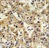 CA6 / Carbonic Anhydrase 6 Antibody - CA6 Antibody IHC of formalin-fixed and paraffin-embedded breast carcinoma followed by peroxidase-conjugated secondary antibody and DAB staining.