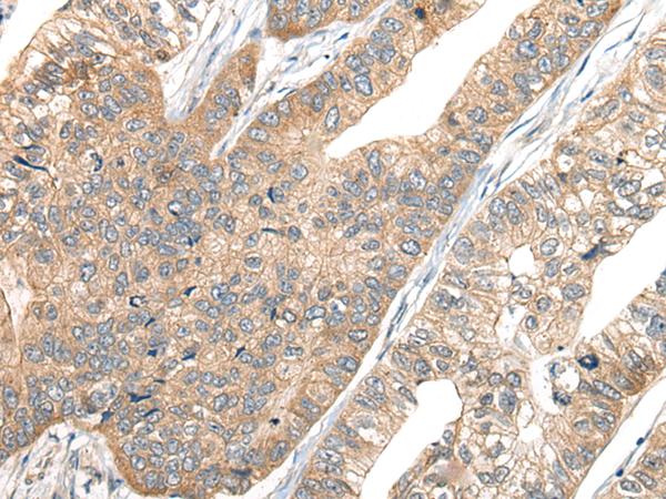 CA7 / Carbonic Anhydrase VII Antibody - Immunohistochemistry of paraffin-embedded Human gastric cancer tissue  using CA7 Polyclonal Antibody at dilution of 1:50(×200)