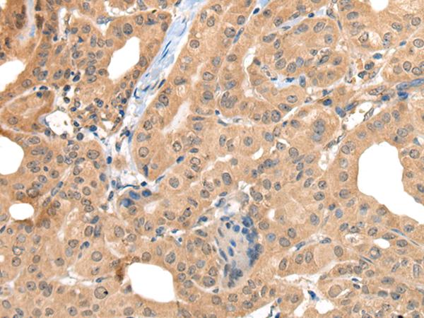 CA7 / Carbonic Anhydrase VII Antibody - Immunohistochemistry of paraffin-embedded Human thyroid cancer tissue  using CA7 Polyclonal Antibody at dilution of 1:50(×200)