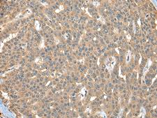 CA7 / Carbonic Anhydrase VII Antibody - Immunohistochemistry of paraffin-embedded Human liver cancer tissue  using CA7 Polyclonal Antibody at dilution of 1:40(×200)