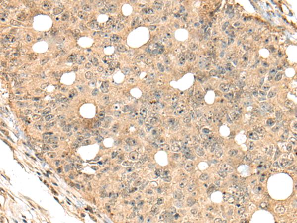 CA7 / Carbonic Anhydrase VII Antibody - Immunohistochemistry of paraffin-embedded Human colorectal cancer tissue  using CA7 Polyclonal Antibody at dilution of 1:40(×200)