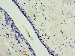 CA8 / Carbonic Anhydrase VIII Antibody - Immunohistochemistry of paraffin-embedded human breast cancer using antibody at 1:100 dilution.