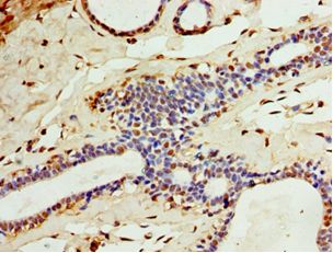 CA8 / Carbonic Anhydrase VIII Antibody - Immunohistochemistry of paraffin-embedded human breast cancer tissue using antibody at 1:100 dilution.