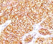 CA9 / Carbonic Anhydrase IX Antibody - Formalin-paraffin human renal cell carcinoma stained with CAIX antibody (66.4.C2). Note cytoplasmic & cell surface staining of tumor cells.