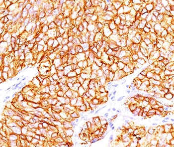 CA9 / Carbonic Anhydrase IX Antibody - Formalin-paraffin human renal cell carcinoma stained with CAIX antibody (66.4.C2). Note cytoplasmic & cell surface staining of tumor cells.