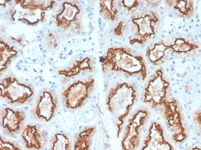 CA9 / Carbonic Anhydrase IX Antibody - Formalin-fixed, paraffin-embedded human Renal Cell Carcinoma Stained with RCC Rabbit Recombinant Monoclonal Antibody (CA9/2993R).
