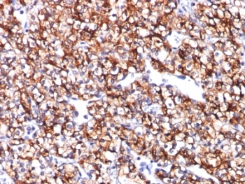 CA9 / Carbonic Anhydrase IX Antibody - Formalin-fixed, paraffin-embedded human renal cell carcinoma stained with CAIX antibody (CA9/781).  This image was taken for the unmodified form of this product. Other forms have not been tested.