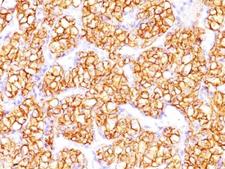 CA9 / Carbonic Anhydrase IX Antibody - Formalin-fixed, paraffin-embedded human renal cell carcinoma stained with Carbonic Anhydrase 9 antibody (PN-15).  This image was taken for the unmodified form of this product. Other forms have not been tested.
