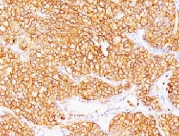 CA9 / Carbonic Anhydrase IX Antibody - Formalin-fixed, paraffin-embedded human renal cell carcinoma stained with CA9 antibody (SPM314).  This image was taken for the unmodified form of this product. Other forms have not been tested.