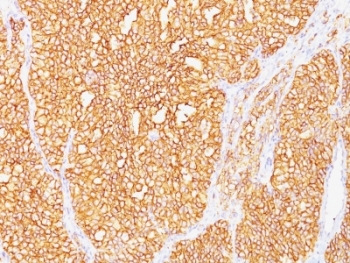 CA9 / Carbonic Anhydrase IX Antibody - Formalin-fixed, paraffin-embedded human renal cell carcinoma stained with Carbonic Anhydrase IX antibody (SPM487).  This image was taken for the unmodified form of this product. Other forms have not been tested.