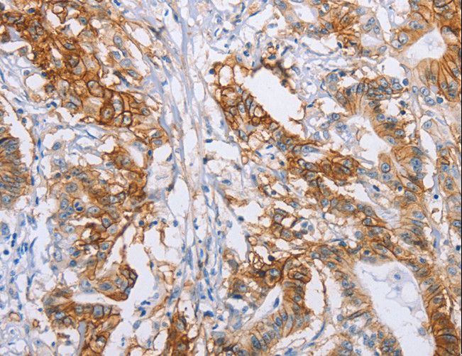 CA9 / Carbonic Anhydrase IX Antibody - Immunohistochemistry of paraffin-embedded Human liver cancer using CA9 Polyclonal Antibody at dilution of 1:50.