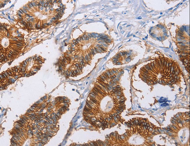 CA9 / Carbonic Anhydrase IX Antibody - Immunohistochemistry of paraffin-embedded Human liver cancer using CA9 Polyclonal Antibody at dilution of 1:40.