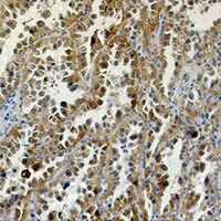 CA9 / Carbonic Anhydrase IX Antibody - Immunohistochemical analysis of Carbonic Anhydrase 9 staining in human lung cancer formalin fixed paraffin embedded tissue section. The section was pre-treated using heat mediated antigen retrieval with sodium citrate buffer (pH 6.0). The section was then incubated with the antibody at room temperature and detected using an HRP conjugated compact polymer system. DAB was used as the chromogen. The section was then counterstained with hematoxylin and mounted with DPX.