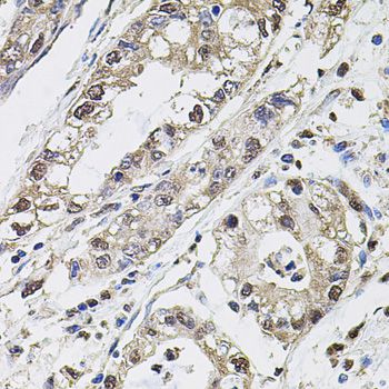 CA9 / Carbonic Anhydrase IX Antibody - Immunohistochemistry of paraffin-embedded human gastric cancer using CA9 antibody at dilution of 1:100 (40x lens).