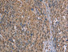 CAB39 / MO25 Antibody - Immunohistochemistry of paraffin-embedded Human cervical cancer using CAB39 Polyclonal Antibody at dilution of 1:50.