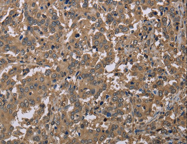 CAB39 / MO25 Antibody - Immunohistochemistry of paraffin-embedded Human liver cancer using CAB39 Polyclonal Antibody at dilution of 1:40.