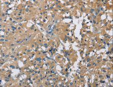 CAB39L Antibody - Immunohistochemistry of paraffin-embedded Human thyroid cancer using CAB39L Polyclonal Antibody at dilution of 1:40.