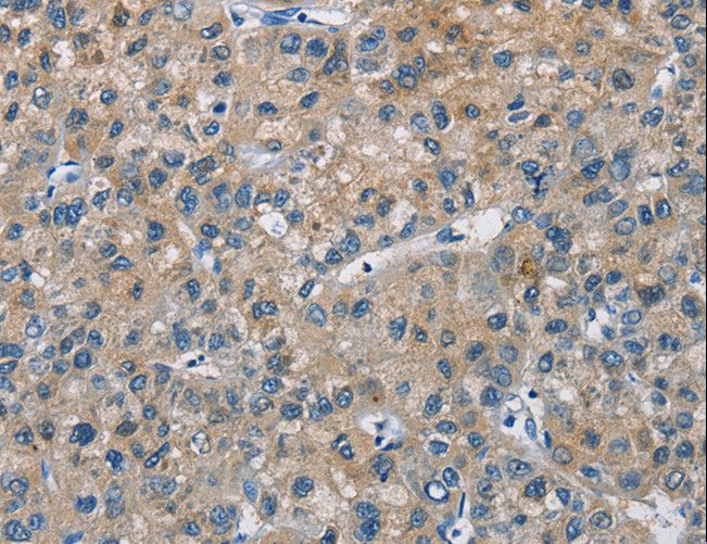 CAB39L Antibody - Immunohistochemistry of paraffin-embedded Human liver cancer using CAB39L Polyclonal Antibody at dilution of 1:30.