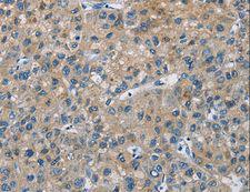 CAB39L Antibody - Immunohistochemistry of paraffin-embedded Human liver cancer using CAB39L Polyclonal Antibody at dilution of 1:30.