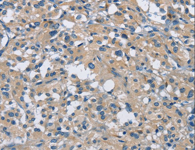 CAB39L Antibody - Immunohistochemistry of paraffin-embedded Human thyroid cancer using CAB39L Polyclonal Antibody at dilution of 1:30.