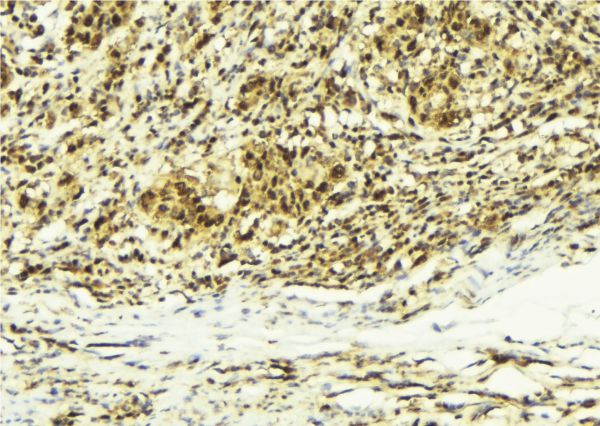 CABIN1 Antibody - 1:100 staining human breast carcinoma tissue by IHC-P. The sample was formaldehyde fixed and a heat mediated antigen retrieval step in citrate buffer was performed. The sample was then blocked and incubated with the antibody for 1.5 hours at 22°C. An HRP conjugated goat anti-rabbit antibody was used as the secondary.