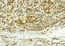 CABIN1 Antibody - 1:100 staining human breast carcinoma tissue by IHC-P. The sample was formaldehyde fixed and a heat mediated antigen retrieval step in citrate buffer was performed. The sample was then blocked and incubated with the antibody for 1.5 hours at 22°C. An HRP conjugated goat anti-rabbit antibody was used as the secondary.