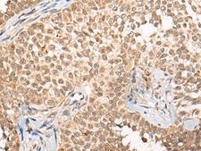 CABIN1 Antibody - Immunohistochemistry of paraffin-embedded Human ovarian cancer tissue  using CABIN1 Polyclonal Antibody at dilution of 1:50(×200)