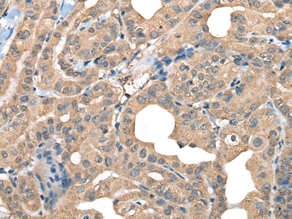 CABP5 Antibody - Immunohistochemistry of paraffin-embedded Human thyroid cancer tissue  using CABP5 Polyclonal Antibody at dilution of 1:65(×200)