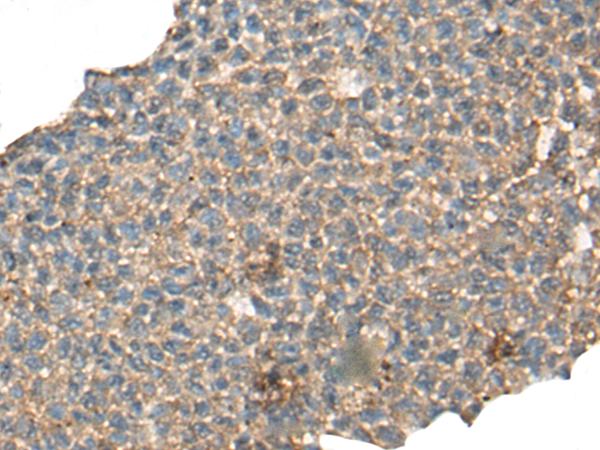 CABP5 Antibody - Immunohistochemistry of paraffin-embedded Human ovarian cancer tissue  using CABP5 Polyclonal Antibody at dilution of 1:65(×200)
