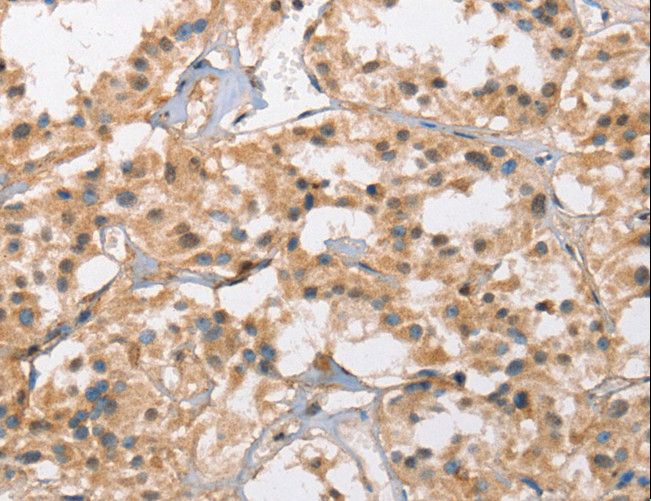 CACNA1D / Cav1.3 Antibody - Immunohistochemistry of paraffin-embedded Human thyroid cancer using CACNA1D Polyclonal Antibody at dilution of 1:40.